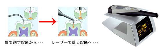 虫歯レーザー診断機：ダイアグノデント ペン